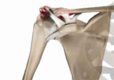 Acromioclavicular (AC) Arthritis