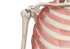 Am I a Candidate for Shoulder Replacement