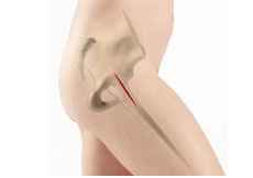 Anterior Hip Replacement