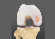 Articular Cartilage Injury