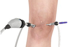 Benefits of Arthroscopic Surgery