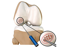 Cartilage Microfracture