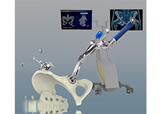 Computer-assisted Hip Replacement