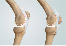 Distal Realignment Procedures