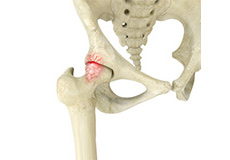 Femoroacetabular Impingement