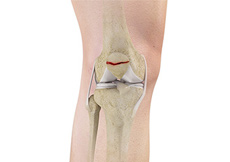 Fractures of the Patella