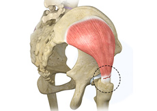 Gluteus Tendon Tear