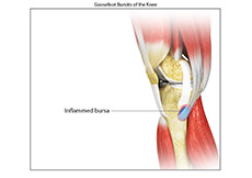 Goosefoot Bursitis of the Knee