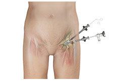 Hip Arthroscopy - Supine Position