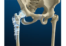 Hip Fracture Surgery