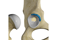 Hip Trauma Reconstruction