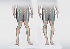Knee Angular Deformities