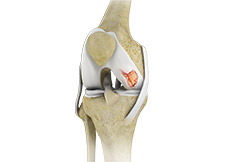 Knee Cartilage Restoration