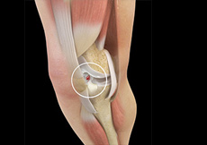 Knee Implants