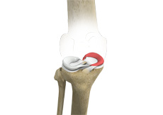 Medial Meniscus Syndrome