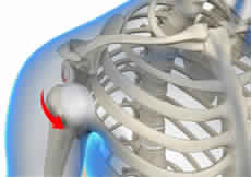 Multidirectional Instability of the Shoulder