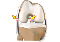 Multiligament Knee Injuries