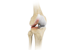 Non-Surgical Knee Treatments