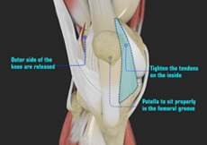 Patellofemoral Instability