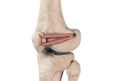 Patellofemoral Knee Replacement