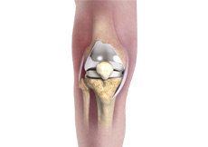 Patient Specific Knee Replacement