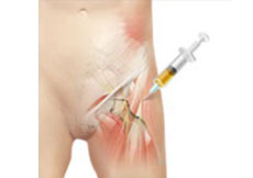 Platelet-Rich Plasma (PRP) Injection