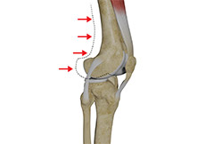 Posterolateral Instability