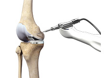 Robotic Assisted Knee Replacement