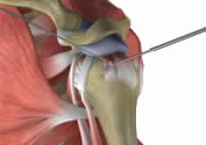 Rotator Cuff Pain