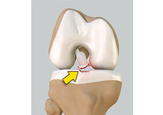 Tibial Eminence Fractures