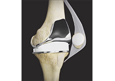 Tricompartmental Knee Replacement